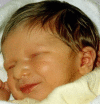 Figure 1. . Newborn male with Pitt-Hopkins syndrome.