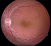 Figure 1. . Fundus photo of a male with congenital retinoschisis.