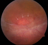 Figure 2. . Fundus photo of the peripheral retina of a male with congenital retinoschisis.