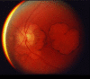 Figure 1. . Funduscopic photo shows extreme macular degeneration of late-stage SCA7.