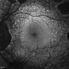 Figure 3. . Fundus autofluorescence image from the left eye of an affected male age 35 years.