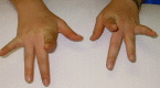 Figure 2. . Individual with Laing distal myopathy attempting to extend her second to fifth fingers.