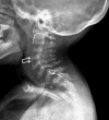Figure 6. . Lateral cervical spine radiograph of a female age six years with MPS IVA.