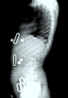 Figure 7. . Lateral spine radiograph of a female age eight years with MPS IVA.