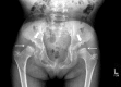 Figure 8. . Hip radiograph of a female age eight years with MPS IVA.
