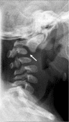 Figure 1. . Cervical spine changes (i.