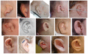 Figure 1. . Range of external ear findings in MFDM.