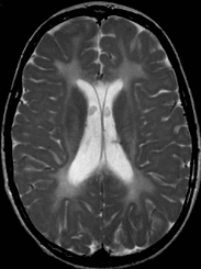 Figure 1. . Axial T2-weighted image shows diffuse hyperintensity of supratentorial white matter consistent with hypomyelination.