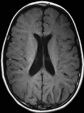 Figure 2. . Axial T1-weighted image shows diffusely isointense white matter with poor demarcation from adjacent gray matter, consistent with hypomyelination.