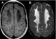 Figure 3. . Axial T1-weighted image (panel A) and axial T2-weighted image (panel B) show areas of increased water content involving the deep frontal white matter.