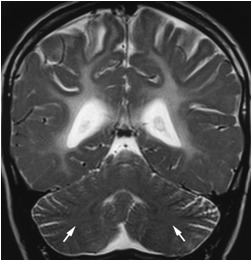 Figure 5. . Coronal T2-weighted image shows poor gray-white matter demarcation at the level of the medullary centers of the cerebellum, suggesting abnormal myelination of the cerebellar white matter.