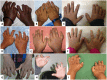 Figure 1. . Hands of different children with MONA showing joint contractures and swelling of the digits at age 4 years (A), 5 years (B), 7 years (C,D), 9 years (E), 10 years (F), 13 years (G,H), and 15 years (I).