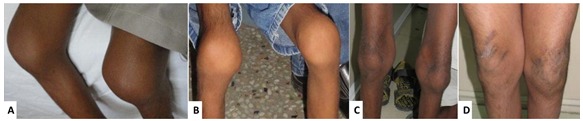 Figure 3. . Swollen knee joints in children with MONA at age 6 years (A), 7 years (B), and 13 years (C,D).