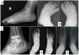 Figure 5. . Radiographs of the feet of affected individuals at ages 5 years (A), 6 years (B), 7 years (C), 9 years (D), and 13 years (E).