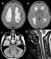 Figure 2. . Axial FLAIR images of the brain (A-C) in a young individual (toddler) with early presentation of LBSL show abnormal signal intensity (with some areas of rarefaction) of almost all cerebral white matter, only sparing the directly subcortical areas.