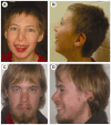 Figure 2. . A male age 11 years (A, B) and a male age 22 years (C,D) with CK syndrome.