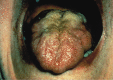 Figure 2. Bulbar onset ALS with tongue atrophy weakness.