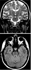 Figure 3. T2-weighted coronal (3a, top) and FLAIR axial (3b, bottom) MRI showing signal changes that reflect Wallerian degeneration in the corticospinal tracts (Courtesy Dr.