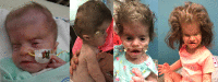 Figure 1. . Facial features of female at age six weeks, six months, one year, and 2.