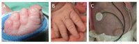Figure 3. . In the same individual at age six weeks (A, B) and six months (C), there is mixed nail dysplasia and aplasia affecting hands and feet (A, B) with syndactyly of the toes and shortened distal phalanges (A, B).