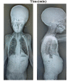 Figure 5. . Skull and spine radiographs of child, age six years, with MBTPS1-related spondyloepimetaphyseal dysplasia with elevated lysosomal enzymes.